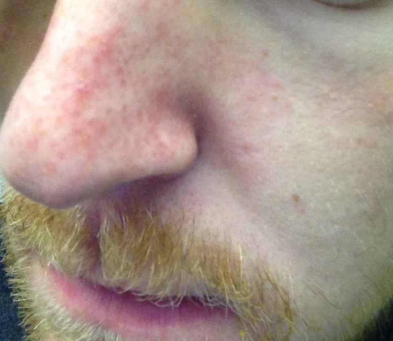 Recurring redness around lips - Dermatology - MedHelp