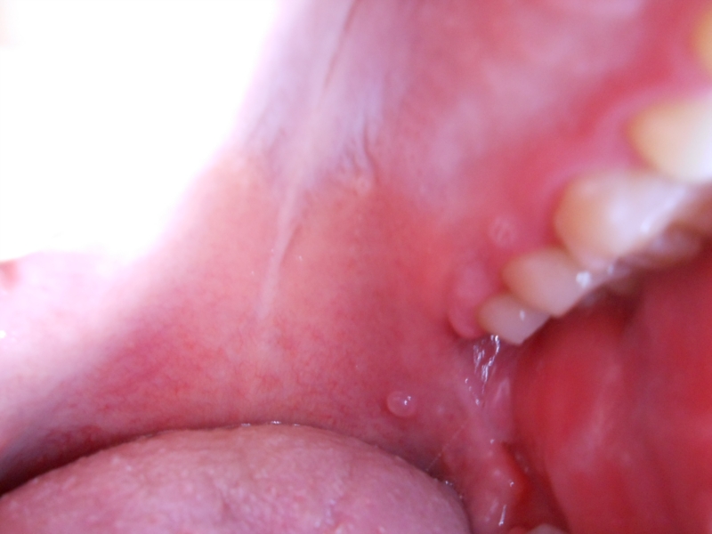 Lumps On Roof Of Mouth 53