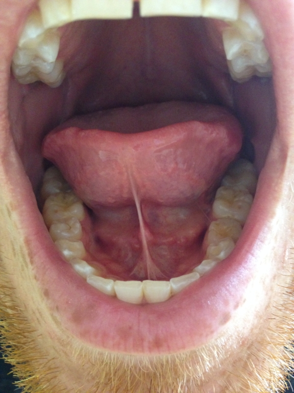 Bump On Floor Of Mouth 3
